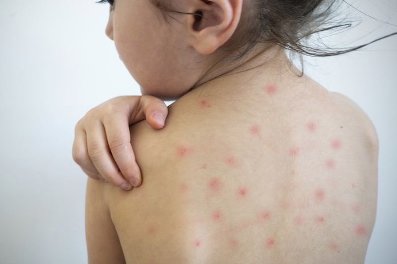 Oshi Health How Measles Outbreaks Affect People With IBD
