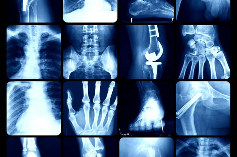 ulcerative colitis affects the entire body including joint pain and inflammation
