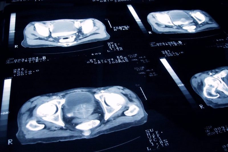 Prostate cancer screening slide; important for men with IBD